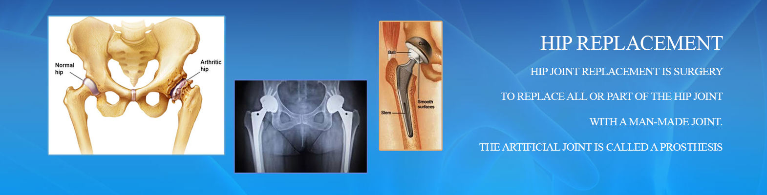 Joint replacement in jaipur