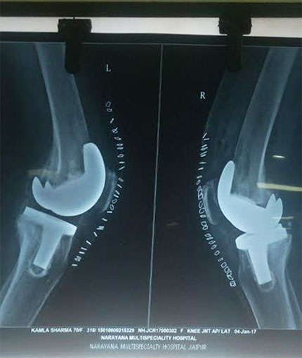 Joint replacement in jaipur